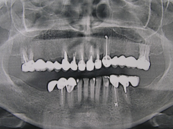 Photo 1.Panoramic roentgenogram of a 55-year-old patient T. before treatment