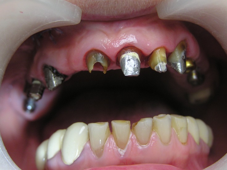 Photo 2.Oral cavity of the patient after insertion of Alpha Dent Implants