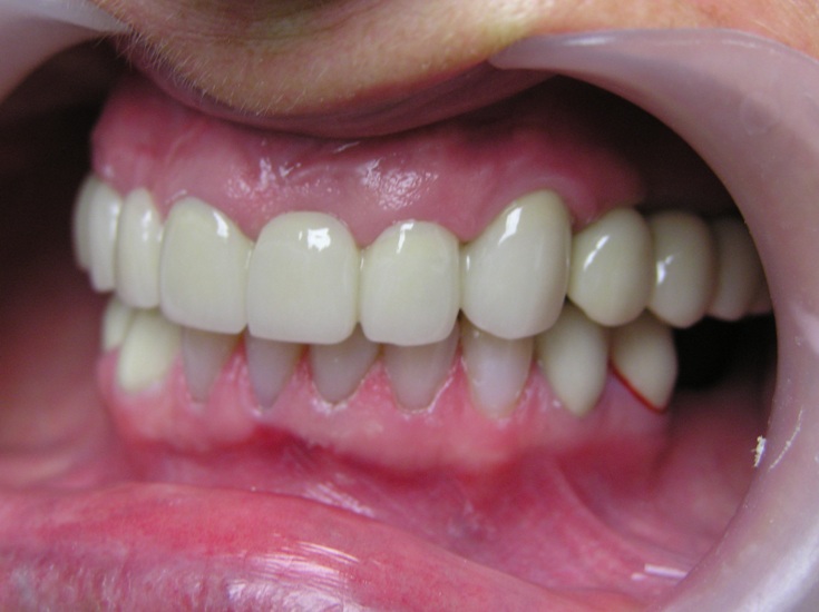 Photo 5. Photo of oral cavity after insertion of Alpha Dent Implants and restoration of dentition defect in the area of 14, 15, 16, 17, 24, 25 and 26 teeth with permanent metal -ceramic crowns