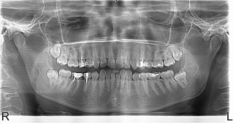 Photo 1.Panoramic roentgenogram of a 46-year-old patient A. before treatment.