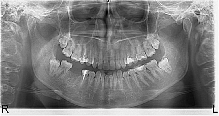 Photo 2.Panoramic roentgenogram of the patient after extraction of her 46th tooth and osteoplasty.