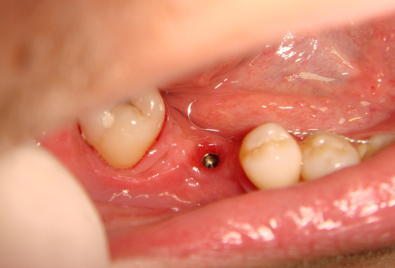 Photo 3. Oral cavity of the same patient: state of alveolar process, dentition and mucous membrane in the area of mandibular dentition defect at site of 46th tooth after implantation and formation of mucous membrane.