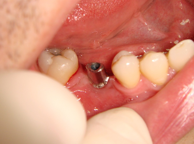 Photo 4. Oral cavity of the same patient: state of alveolar process, dentition and mucous membrane in the area of mandibular dentition defect.