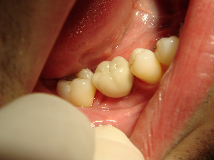 Photo 5. Oral cavity of the same patient in six months after surgery on placement of Alpha Dent Implant and restoration of dentition. There is a metal -ceramic crown placed at site of 46th tooth fixed on individual abutment.