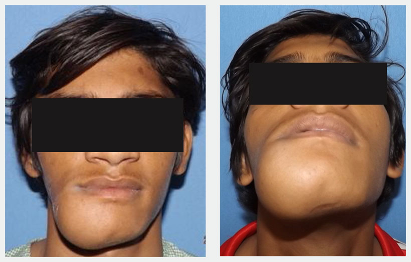 Fig 1: Pre operative photo of 18 year old boy Mr. V. N. showing hard, non fluctuant, non tender swelling over Right side of mandibular parasymphysis-body region extending from right corner of mouth to upper part of neck and midline to body of mandibular area.