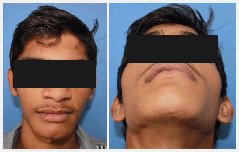 Fig 10: Eight month post operative photos show normal face. no external deformation on the face.