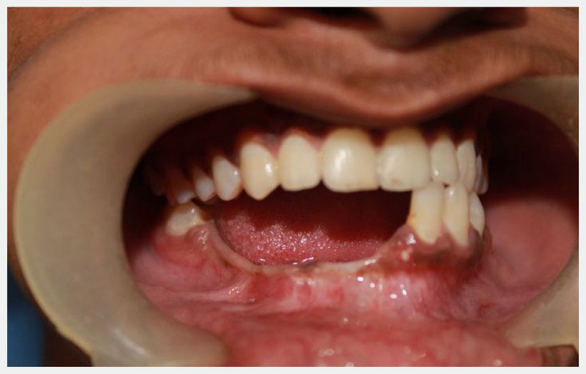 Fig 11: Show healing of lower ridge after 8 months. occlusion is normal.