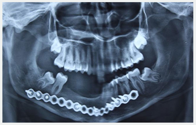 Fig 12: Eight month post op opg shows new bone formation with good quality to support the implant.