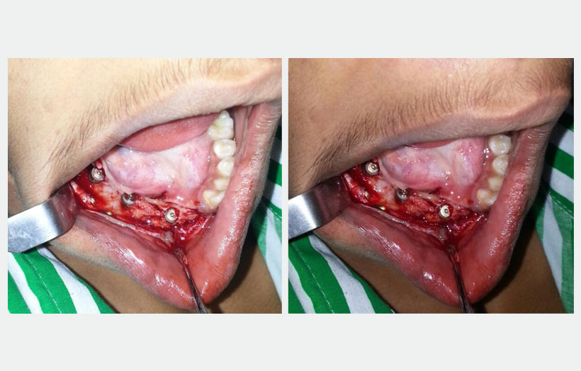 Fig 13: Shows alpha dent classic 5×13 mm three implants in situ in new bone.