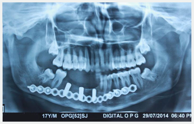 Fig 14: Shows 15 days post op x-ray showing Alpha Dent implant in situ.