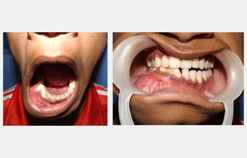 Fig 2: Pre operative Intra operative view showing hard bony swelling obliterating buccal vestibule from lower left central incisor to lower right first molar region.
