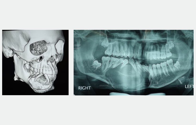 Fig 3: 3D CT of face and X-ray OPG show well defined, unilocular radiolucent area with cotton wool appearance and well demarcated radio-opaque border extending from lower left central incisor to lower right first molar area. There is expansion of both buccal and lingual plate.