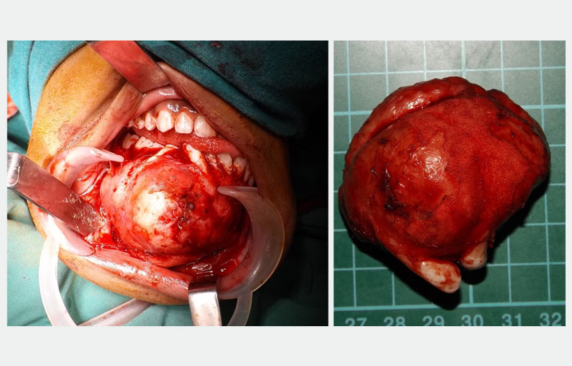 Fig 4: Show the lesion covered with thin shell of bone after mucoperiosteal flap reflection. Show 5×7 cm lesion after excision. Histopathology report suggests the lesion is Ossifying Fibroma.