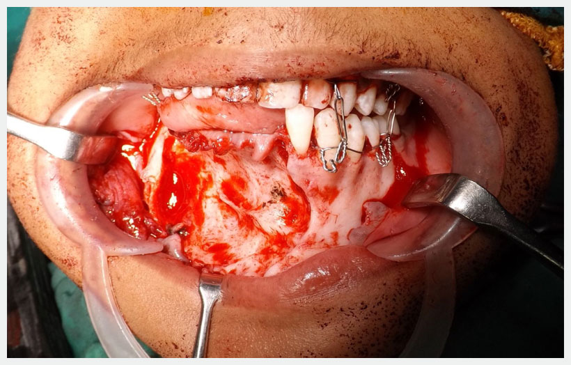 Fig 5: Shows the defect in the mandible after excision of lesion. Very thin shell of bone is left behind after excision. 2.5mm Reconstruction plate is fixed to the defect area to avoid pathologic fracture and Intermaxillary fixation done.