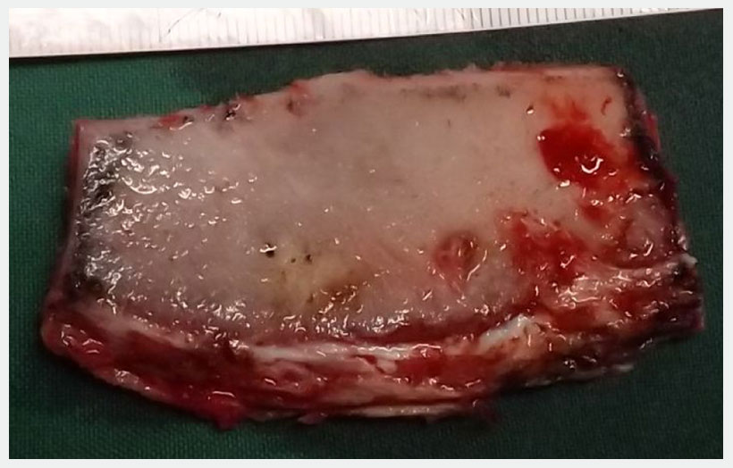 Fig 6: iliac crest cortico-cancellous bone graft harvested from right iliac crest region of about 7x5cm.