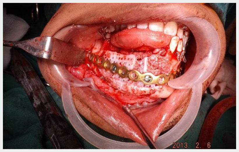 Fig 7: Graft fixed to mandibular defect using reconstruction plate and screw.