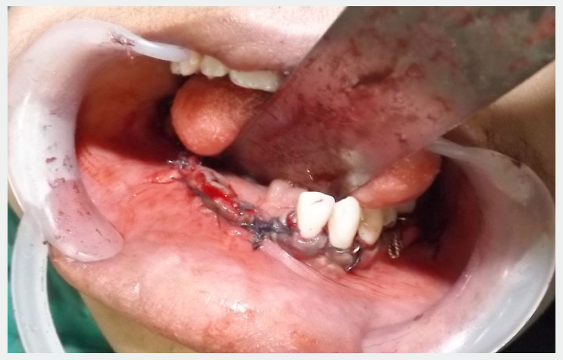 Fig 8: After defect closure.