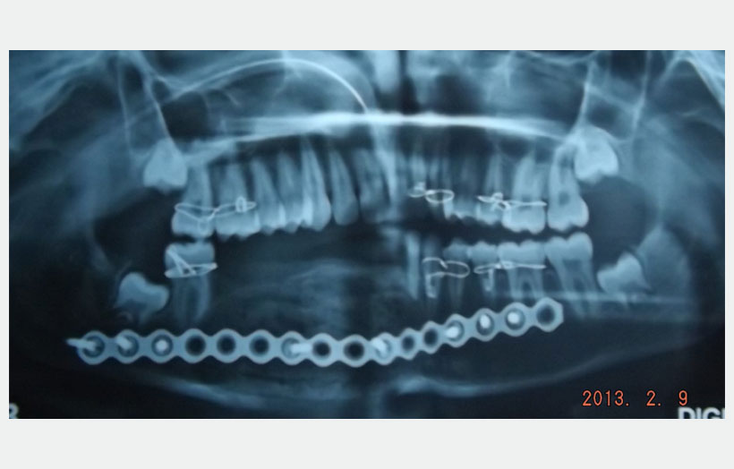 Fig 9: Immediate post op x-ray OPG.