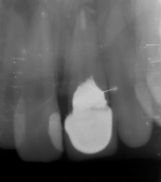 Photo 1. Initial clinical situation. Absence of coronal part of the tooth for adequate fixation of orthopedic construction.