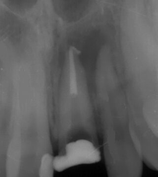 Photo 2. Availability of periapical changes in the region of the 21st tooth.
