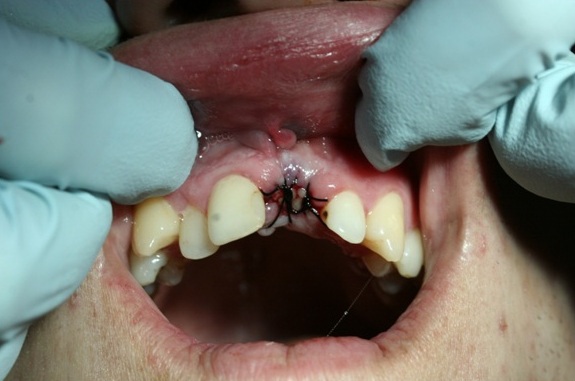 Photo 3. Oral cavity after the surgery.