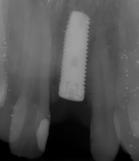Photo 4. Control enlargement X-ray film