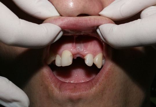 Photo 5. Clinical situation in a fortnight after the surgical stage.