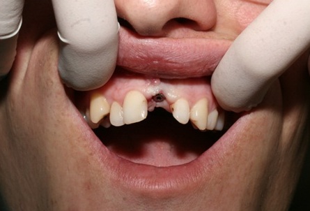 Photo 6.Opening the implant and placement of a gingival former.