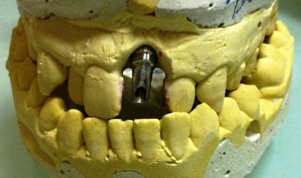 Photo 7.Orthopedic stage of permanent construction manufacture. Use of anatomic abutment.