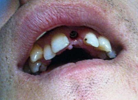 Photo 8. Clinical situation before placement of abutment