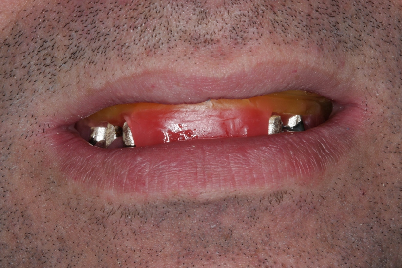 Photo 10. Fixation of central occlusion with the wax rolls.