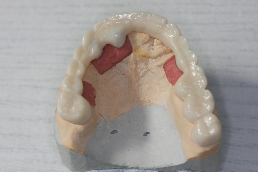 Photo 11. Temporary plastic maxillary bridge