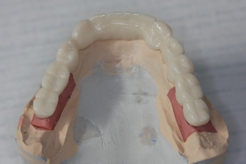 Photo 12. Temporary plastic mandibular bridge.