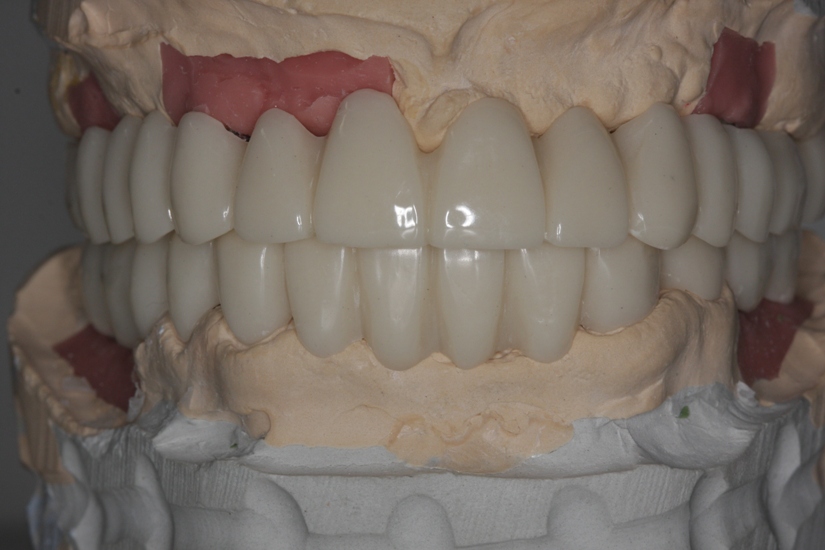 Photo 13. Temporary plastic prostheses after placement of implants.