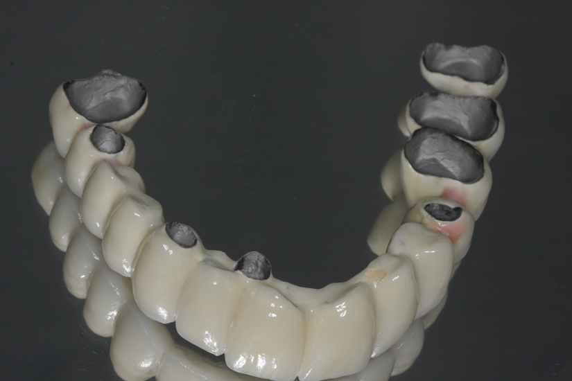Photo 14. Metal-ceramic bridge prosthesis.