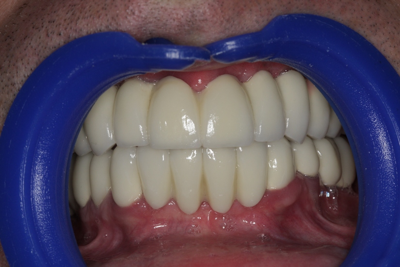 Photo 15. Finished fixed orthopedic constructions in the oral cavity.