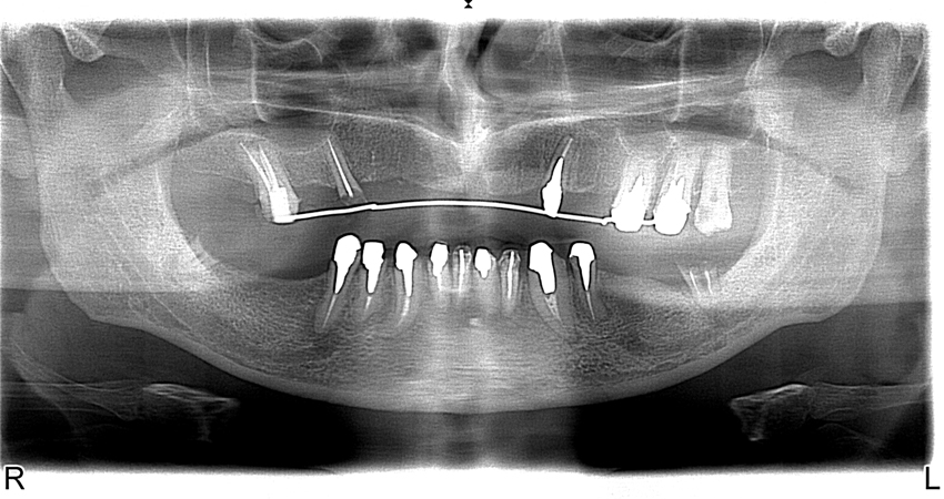 Photo 2.Patient’s orthopantomogram at the stage of planning.