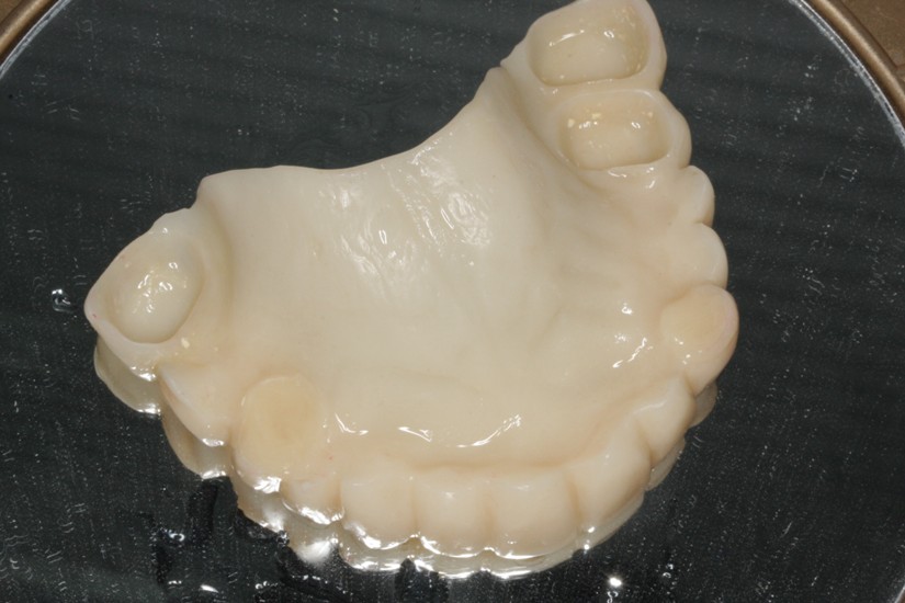 Photo 3.Temporary removable dental prosthesis after extraction of teeth.