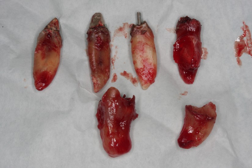 Photo 4. Single-stage extraction of 15, 23, 31, 32, 38, 41, 42 and 48 roots of teeth.