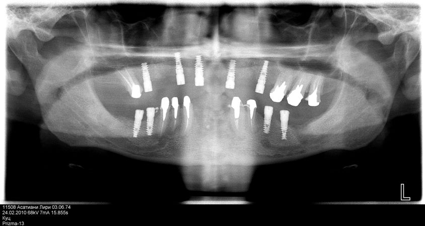 Photo 5.Control orthopantomogram after operation.