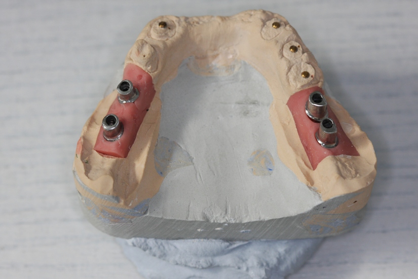 Photo 6.Individual mandibular abutments.