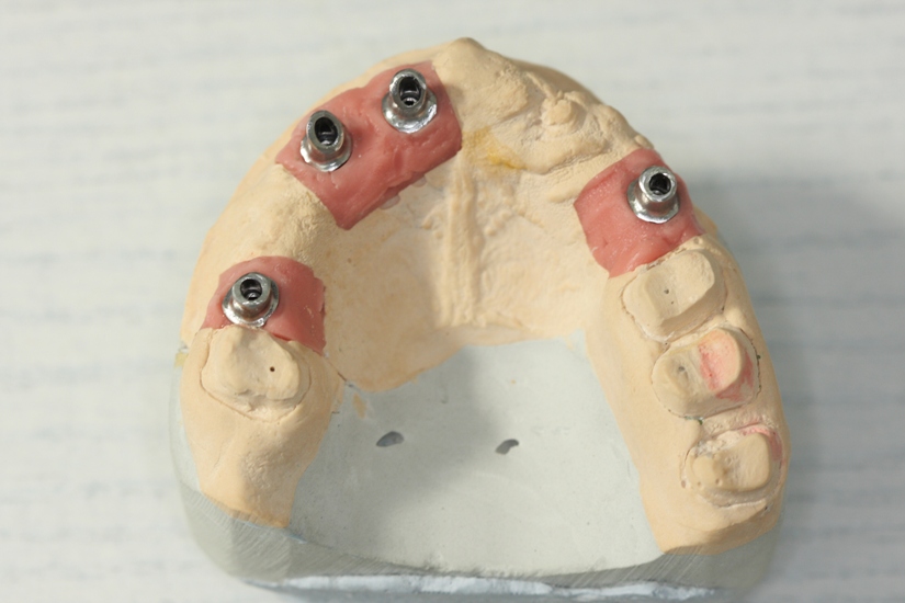 Photo 7.Individual maxillary abutments.
