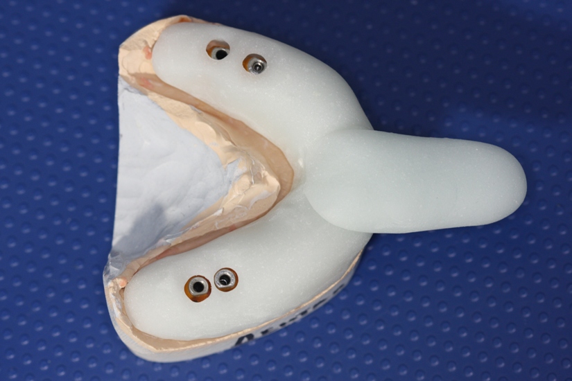 Photo 8.Individual mandibular spoon.