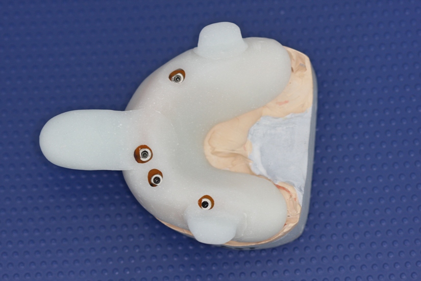 Photo 9.Individual maxillary spoon.