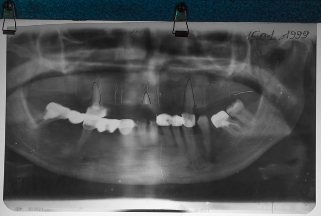 Photo 1.Initial orthopantomogram before treatment (1999)