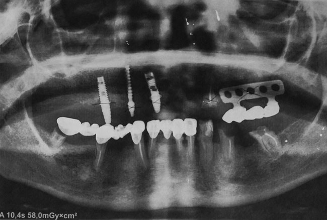 Photo 2.Control orthopantomogram 2013