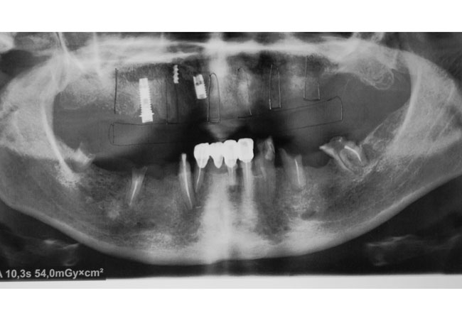 Photo 3.Control orthopantomogram after removal of the unusable implant on the left upper jaw