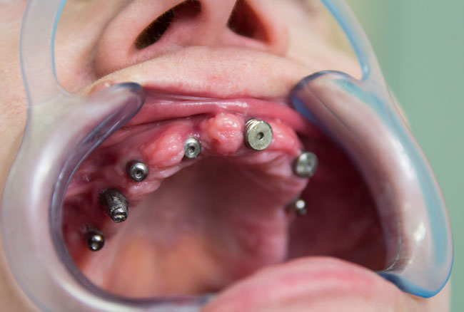Photo 4.Installed Alpha-Dent conditioners of gingival cuff. In the area of 15-year-old implant a 1.5% recovery of titanium 2 made.
