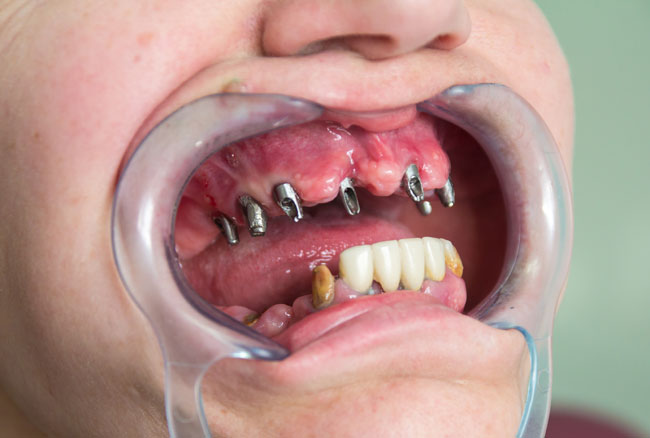 Photo 7.Fitting the abutments in the mouth.